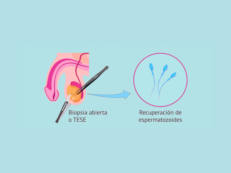 Biopsia-Testicular-Aspiracion-Testicular-o-Epididimaria