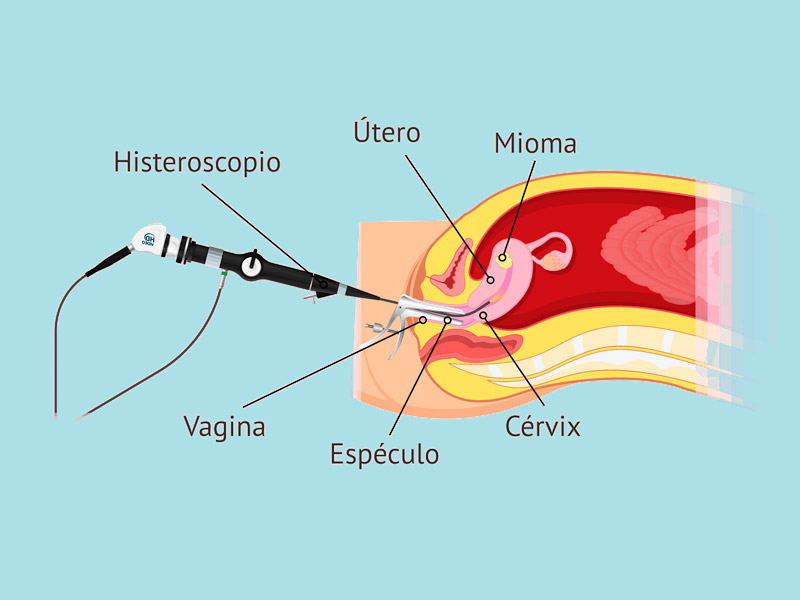 Laparoscopia-e-Histeroscopia-diagnosticas-o-terapeuticas