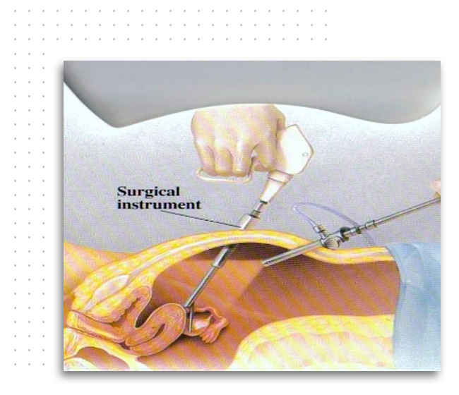 img-Laparoscopia-e-Histeroscopia